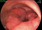 Adenocarcinoma de Sigmoides